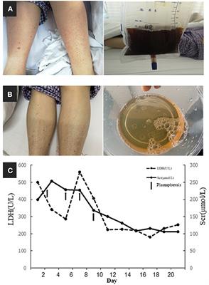 Case Report: Chronic Lymphocytic Leukemia With Recurrent Complement-Mediated Thrombotic Microangiopathy and C3 Glomerulonephritis